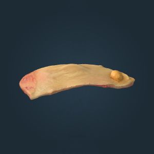 胆囊与胆固醇结石